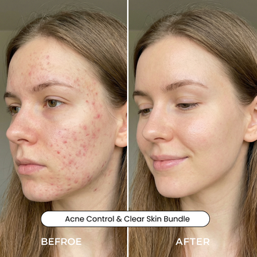 Acne Control & Clear Skin Bundle